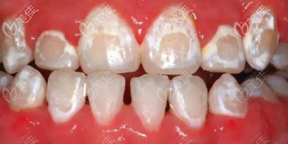我们的牙齿牙釉质表面是有一层钙磷的,起着保护牙齿的作用.