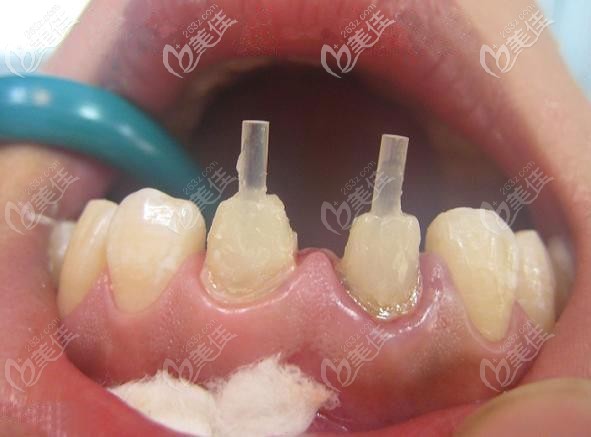二,非金属的桩核: 纤维桩:能对治疗后的牙齿起到保护作用,美观度也