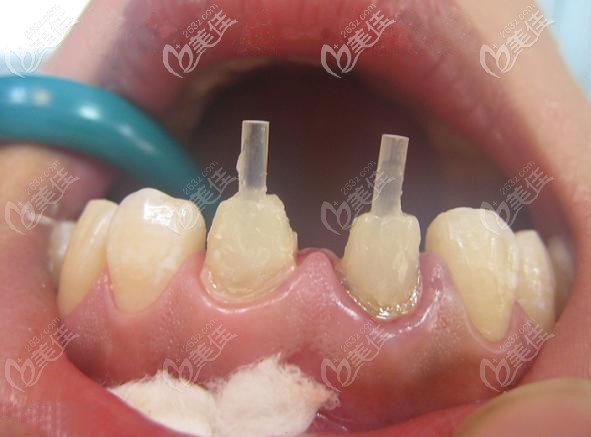 本文有牙齿打桩做冠