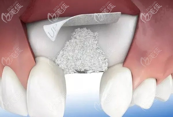种牙什么情况下需要加骨粉是否能一次性完成