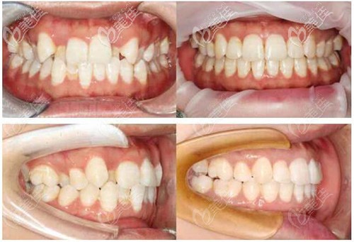 排列不齐矫正方案:拔牙2颗做隐适美隐形矫正矫正后:牙齿整齐,牙缝收缩