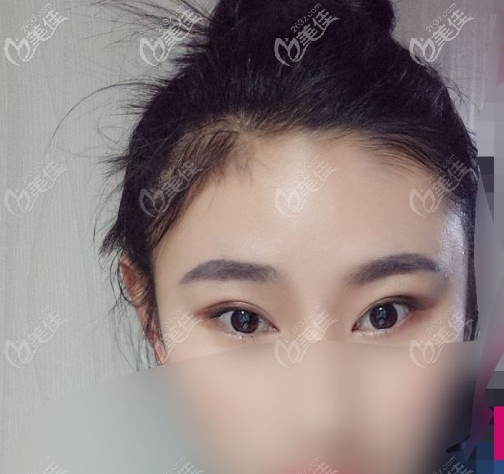 关于吊梢眼适合什么双眼皮和二次修复双眼皮的成功率
