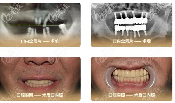 68岁的刘叔讲述在北京中诺第二口腔医院做allon6全口种植牙的经历