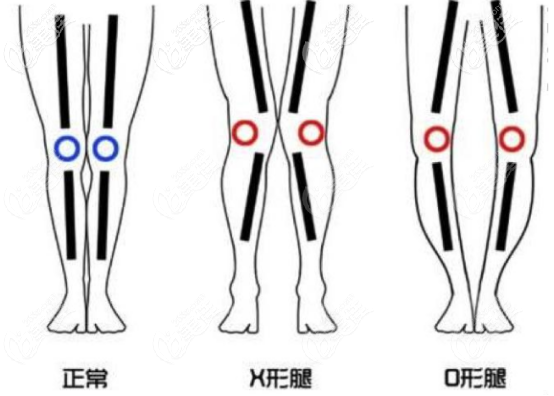 x腿型和o腿型的区别