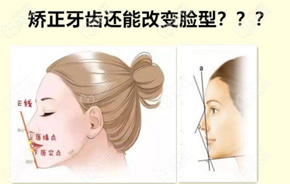 广州这位妞,在越秀区广大口腔做完反颌矫正后脸型都跟着改变了