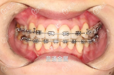 这也是普通金属牙套和自锁牙套的区别. 价格:20000-35000 优点: 1.