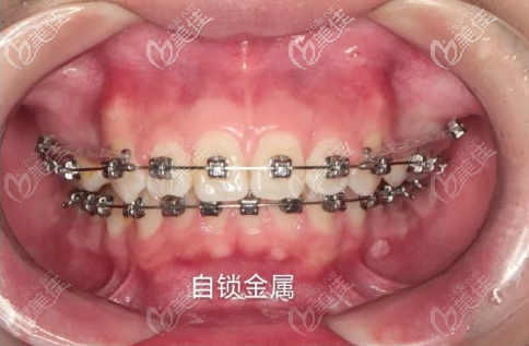这也是普通金属牙套和自锁牙套的区别. 价格:20000-35000 优点: 1.
