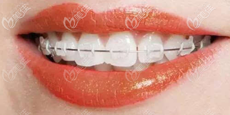 常见牙套的全部种类和价格及图片自锁金属陶瓷自锁全隐形牙套哪个好一
