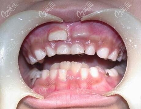 小孩在换牙期出现所谓的"双排牙"