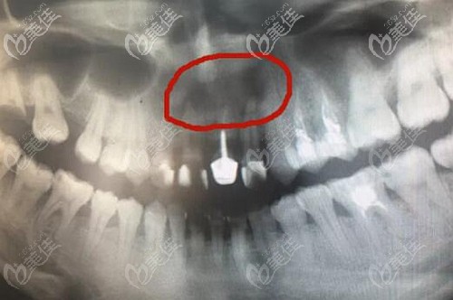 牙根尖虽然有囊肿但不疼可以不管吗?不治疗的后果是啥