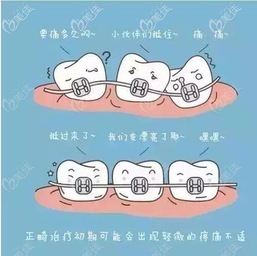 福建三明牙齿矫正多少钱瑞尔口腔说要看你是戴自锁牙套还是隐形牙套