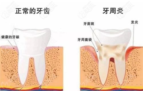 轻度牙周炎想保持40年不掉牙需要经历这四个阶段