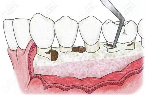 轻度牙周炎如何治疗?分以下4个过程