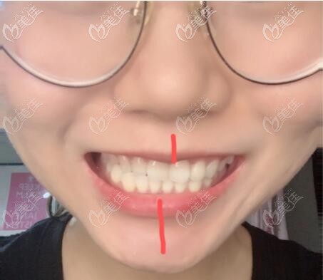 牙齿中线歪了2mm太丑了牙中线不齐导致脸歪的矫正方法和费用安排上