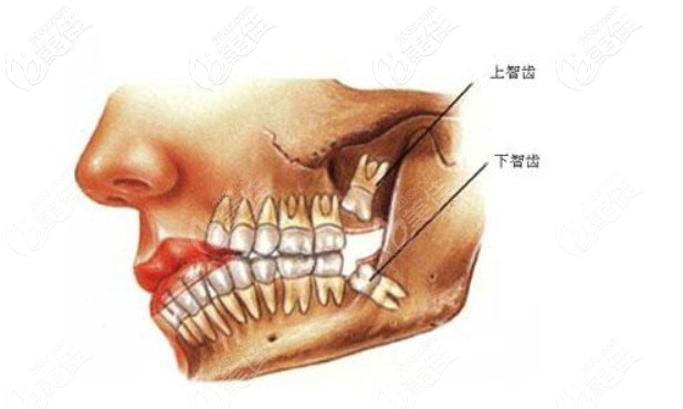 一次性拔4颗智齿会有危险吗?牙医告诉你拔牙四颗一般间隔几天