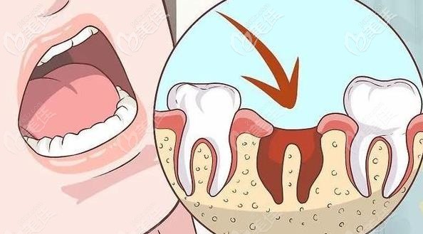 为什么牙医不建议拔完牙后吐口水只是为了避免得干槽症吗