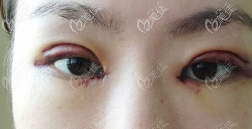 割双眼皮三个月上眼皮发黑能自行恢复吗?需要修复吗?