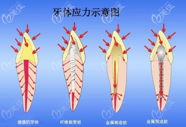 牙齿打桩用金属好还是纤维好 修复前先看金属桩和纤维桩的区别及优