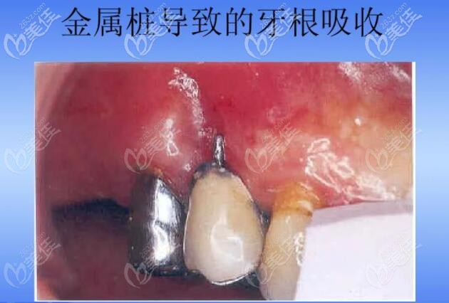 牙齿打桩用金属好还是纤维好修复前先看金属桩和纤维桩的区别及优缺点