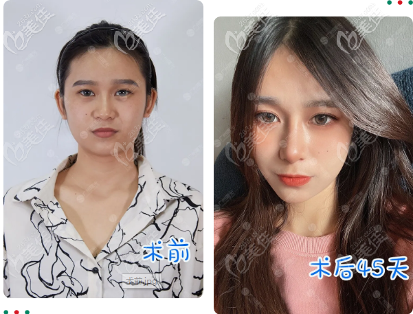 双侧耳软骨隆鼻已经45天前后对比图片