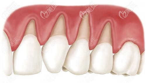种植牙填骨粉指的自体骨牙龈萎缩,骨量条件不足以种植,所以需要在