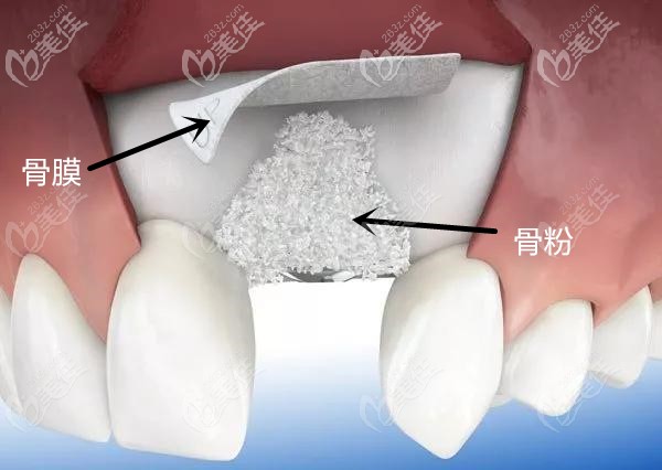 种牙植入骨粉后可能发生少量骨粉外漏,属于正常现象,但是 如果感觉有