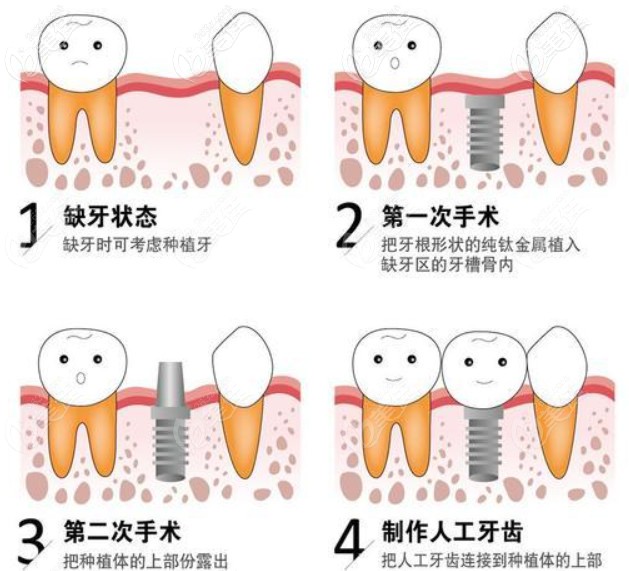 微创即刻种植牙和普通种植牙哪个好其区别在于它们的种植过程步骤哦