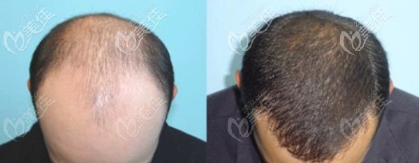 荆州华美头顶脱发大面积植发案例效果分享看男性地中海脱发怎么长回来