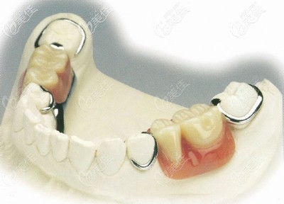 半口牙缺失采用活动义齿