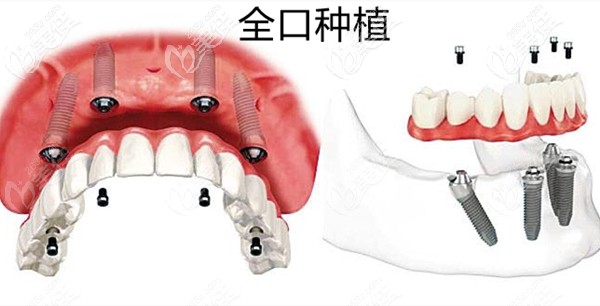 杭州哪个私立牙科医院做种植牙比较好而且种牙费用大众化看完秒懂