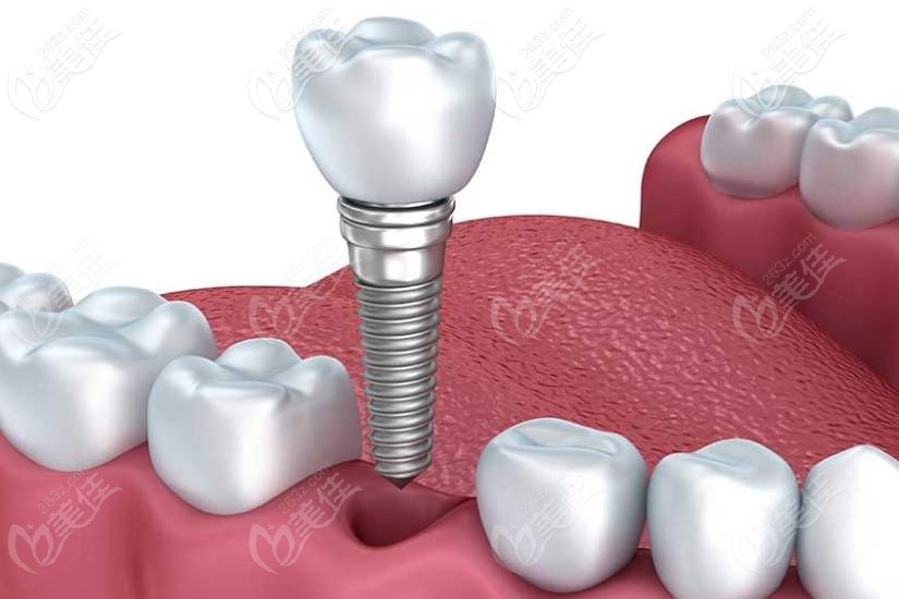 急求种植牙和冠桥修复的区别告知优缺点可判断牙齿缺失选哪个好