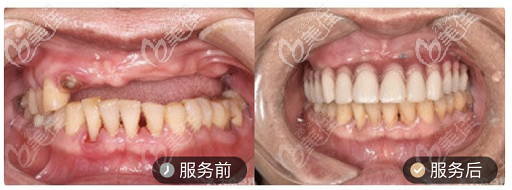 深圳希奥口腔半口种植牙案例
