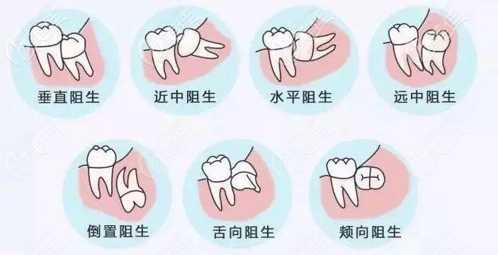 秦皇岛口腔常见的阻生智齿类型