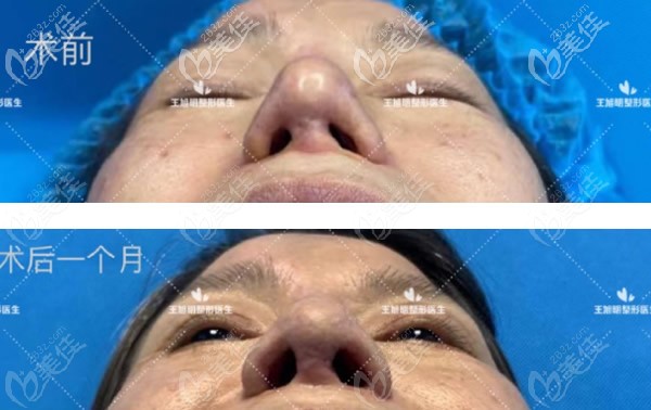 王旭明院长鼻假体取出案例