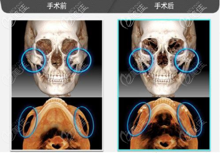 预约曹栋弼医生磨骨到哪家医院不知道到他做颧骨内推技术怎样