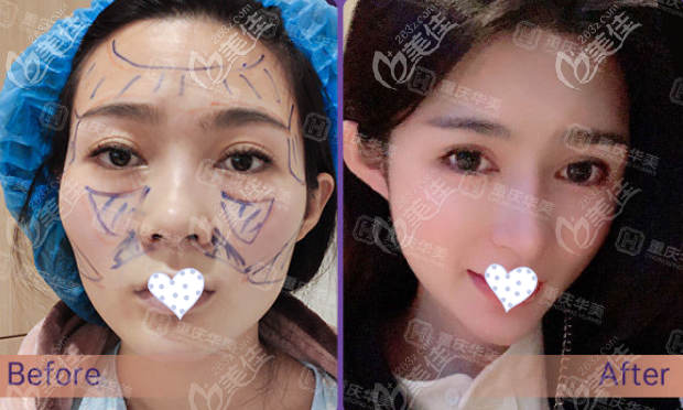 重庆华美自体脂肪全脸填充效果图