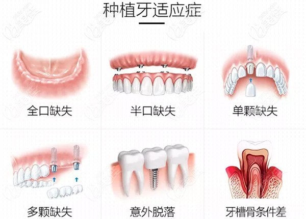 该种植牙体系基本不受年龄限制,对于单颗多颗或者全上颌/全下颌缺牙