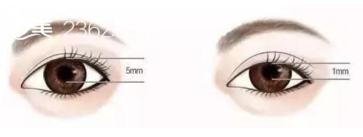 济南伊美尔整形5S重睑双眼皮术，黑眼球要充分暴露