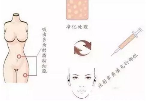 自体脂肪填充面部过程