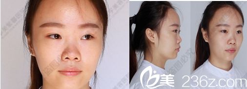 四川华美紫馨医学美容医院的鼻综合手术术前照片