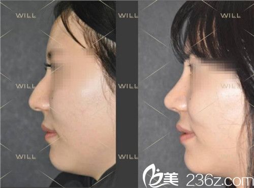 will医院硅胶隆鼻整形案例术前术后对比
