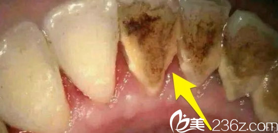 <!--<i data=20240703-sp></li>
<li><i data=20240703-sp></i>-->医院——洗牙——牙结石牙菌斑