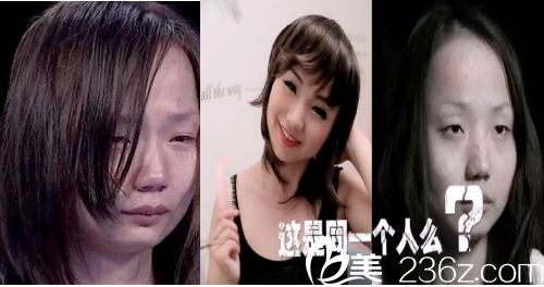 广州华美医院阮庆玲医生给妹子做双眼皮手术的术前照片 广州华美医院阮庆玲医生给妹子做双眼皮手术的术前照片