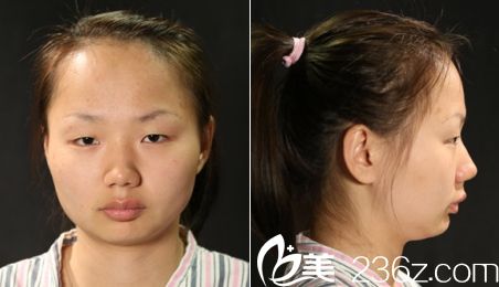 广州华美医院阮庆玲医生做双眼皮手术前侧面和正面的照片