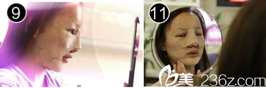 凯莉在广州华美医院做双眼皮手术后的恢复图 凯莉在广州华美医院做双眼皮手术后的恢复图