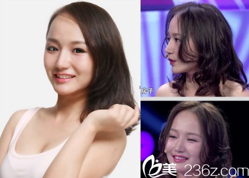 凯莉在广州华美医院阮庆玲医生手下做双眼皮手术后恢复后的图片 凯莉在广州华美医院阮庆玲医生手下做双眼皮手术后恢复后的图片