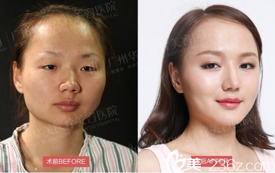 广州华美医院阮庆玲医生做双眼皮手术前后的对比图