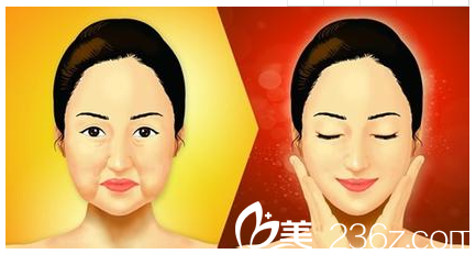 北京米兰柏羽丽都整形美容医院嘴角下垂图