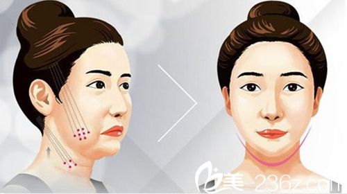 沈阳名流PPDO多维线雕提升术