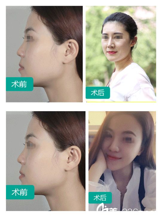 石家庄雅芳亚鼻综合整形案例 石家庄雅芳亚鼻综合整形案例